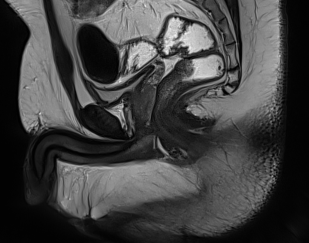 Magnetic resonance imaging of the external genital organs of men