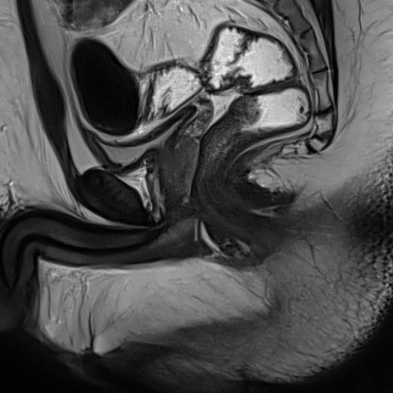 Magnetic resonance imaging of the external genital organs of men