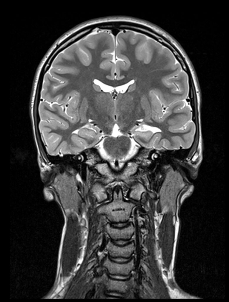 Գլխուղեղի ՄՌՏ «էպիլեպսիա պրոտոկոլ»
