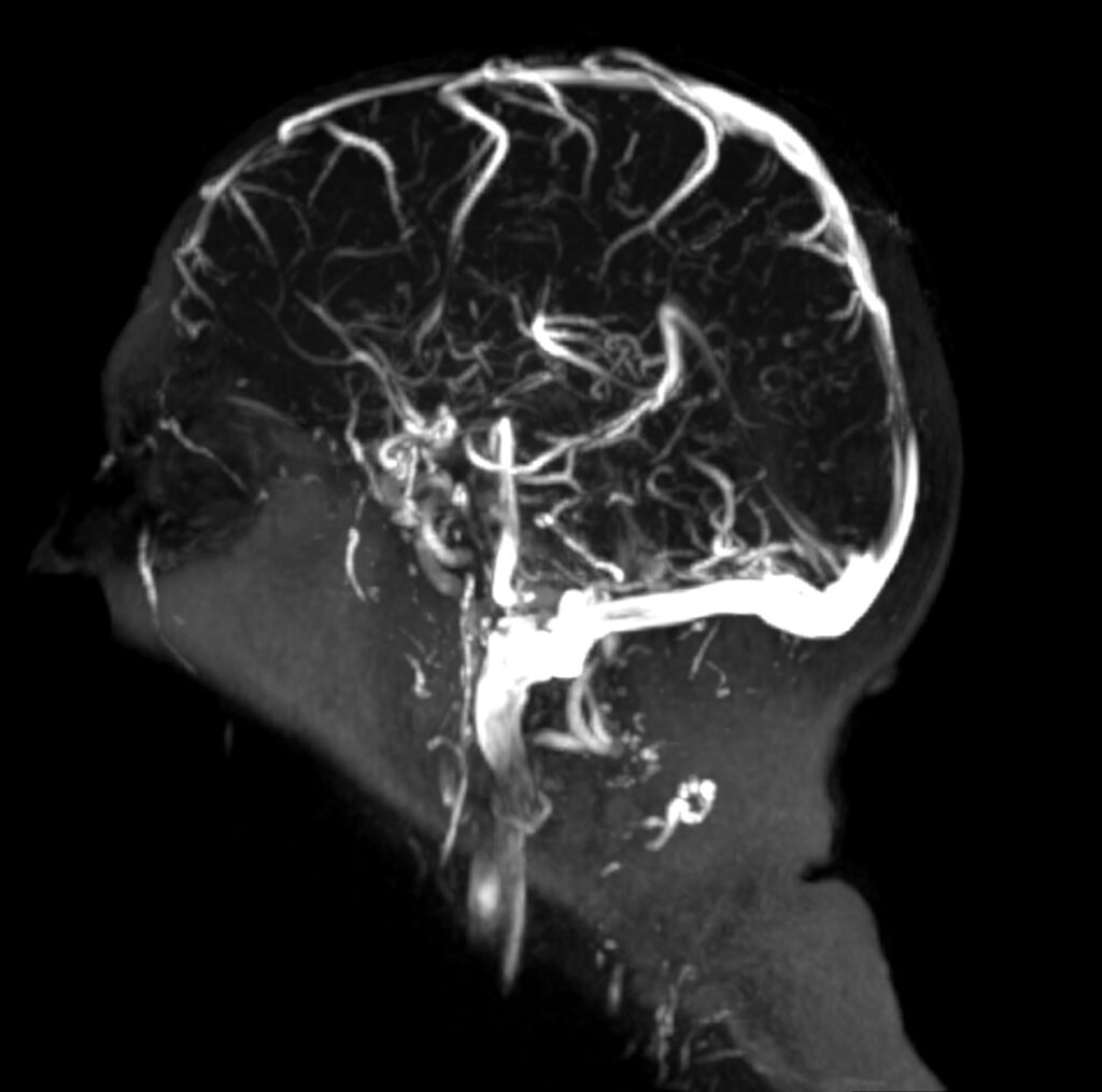 Գլխուղեղի ՄՌՏ + ՄՌ վենոգրաֆիա